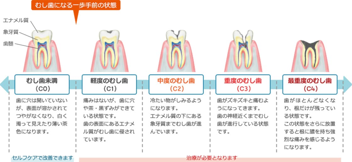 むし歯の症状と進行