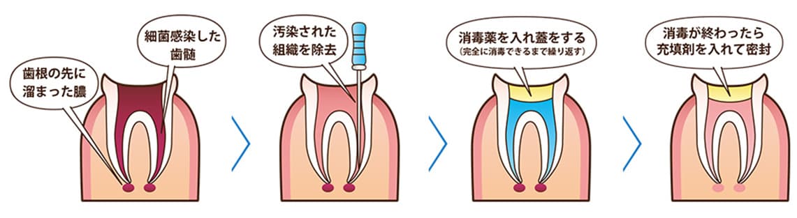 根管治療