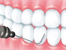 歯石・歯垢を除去