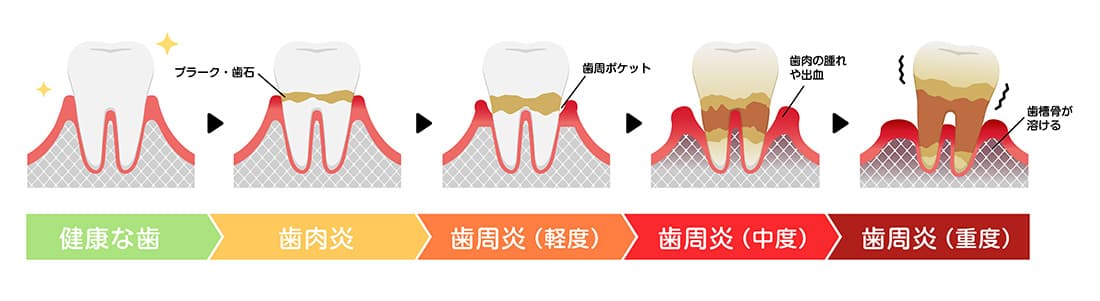 歯周病の進行