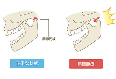 顎関節症